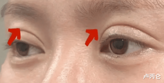 人的一辈子，可以做几次双眼皮？